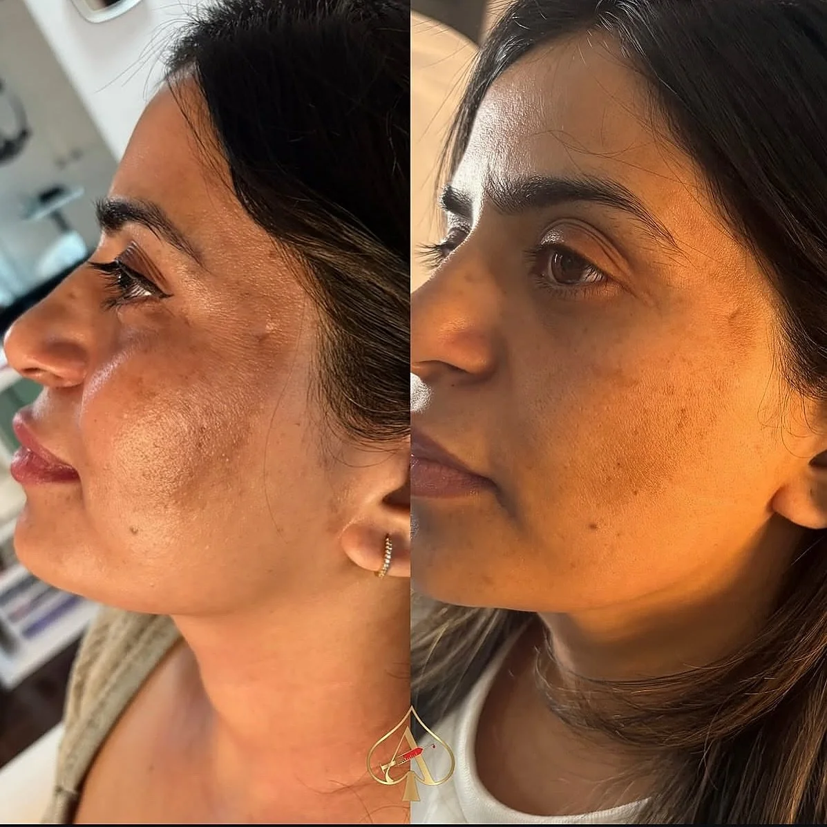 Pigmentation stealing your glow? ✨

This is your sign to stop covering it&hellip; and start correcting it &spades;️

Our Salmon DNA Facial (PDRN therapy) is one of Ace&rsquo;s favourite treatments for restoring brighter, smoother, more even-toned ski