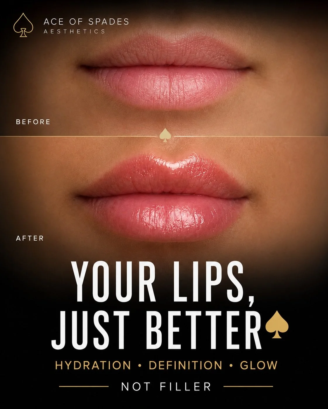 Not ready for filler? Your lips still have options. &spades;️

Sometimes your lips are simply thirsty.

Introducing our newest lip booster treatment designed to hydrate, smooth, brighten, and enhance your natural lip colour without adding traditional