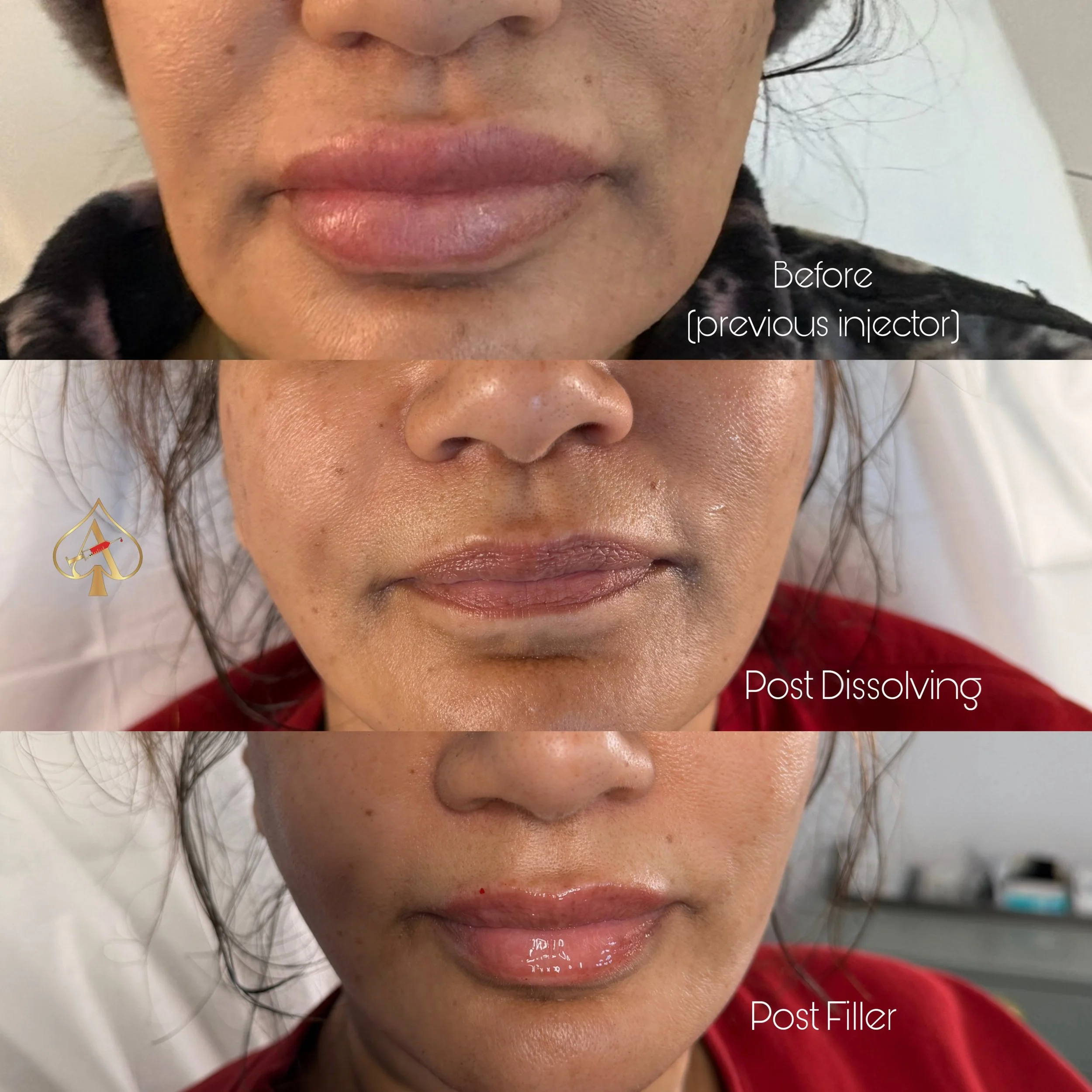 Cheaper isn&rsquo;t always cheaper.

Sometimes the most expensive filler appointment is the one you have to fix later.

Swipe to see:
➡️ Previous filler (done by someone else)
➡️ Dissolving
➡️ Refilled with 1.1ml

A good result isn&rsquo;t about how 