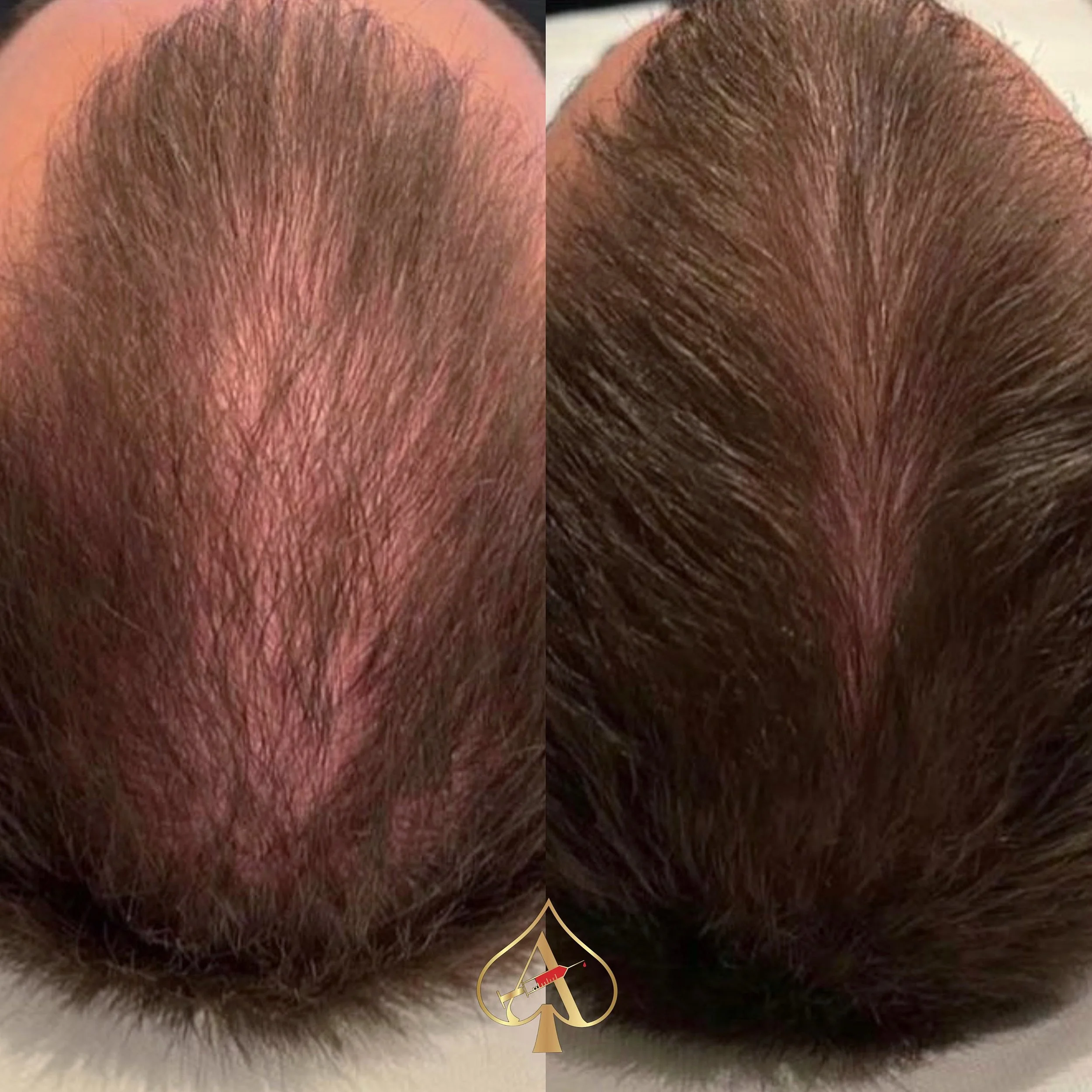 Still waiting for that hair serum to work?

PRF Hair Restoration uses your body&rsquo;s own growth factors to help support stronger, healthier hair from the inside out. &spades;️

By concentrating the healing properties found in your blood, PRF can h