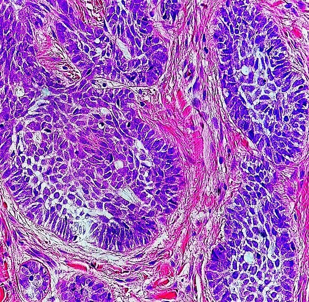 Histological image of basal cell carcinoma.