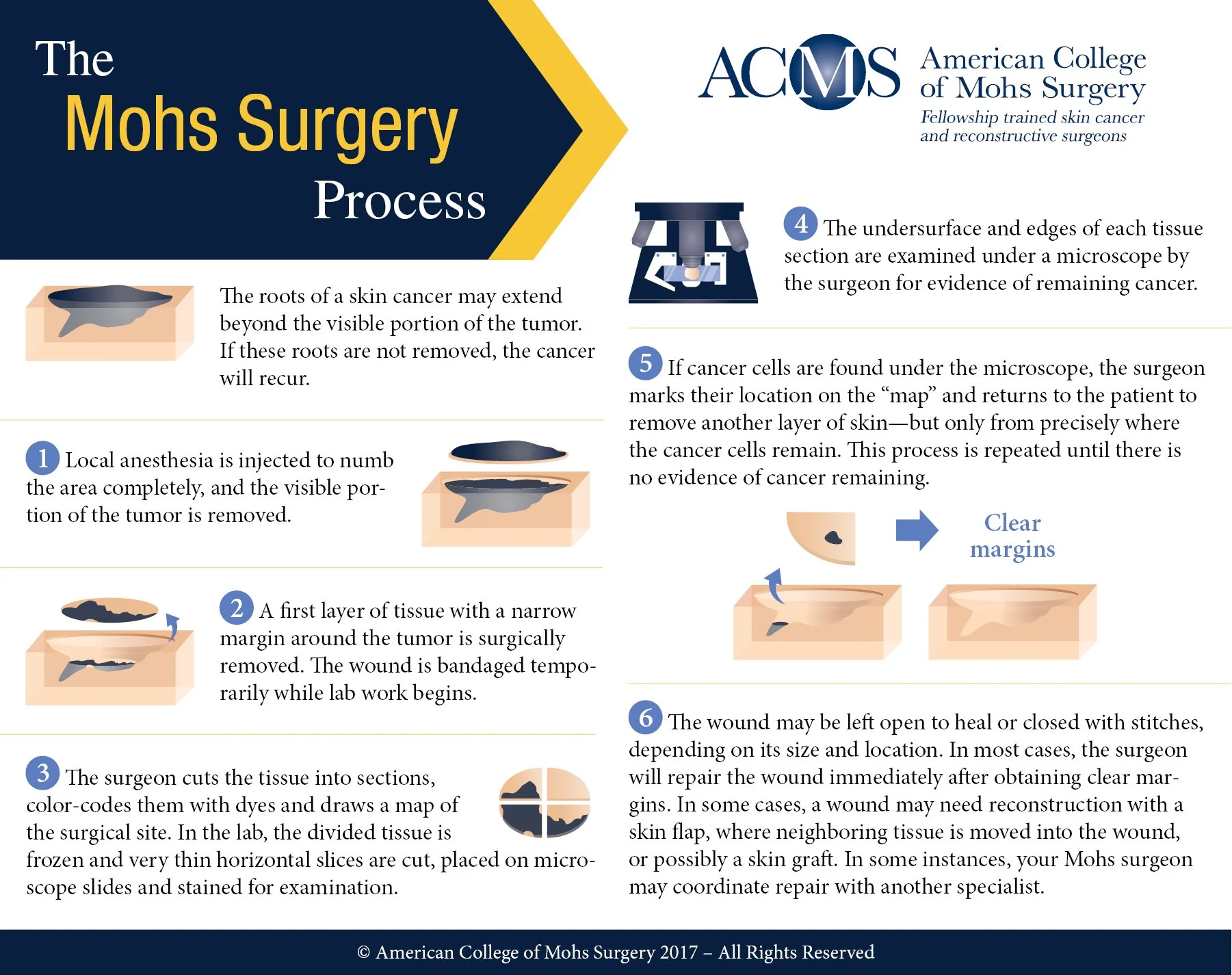 Mohs Surgeyr Process Infographic