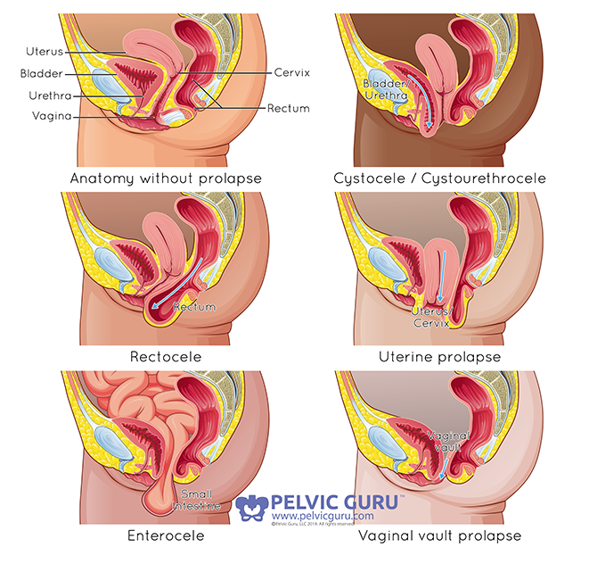 Pelvic Organ Prolapse 101 — Healthy Mumma & Baby