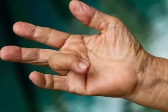 Trigger Finger vs Dupuytren’s Contracture