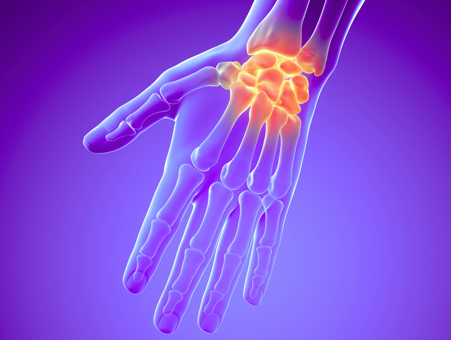 Carpal Tunnel vs. Cubital Tunnel Syndrome:What’s the Difference?