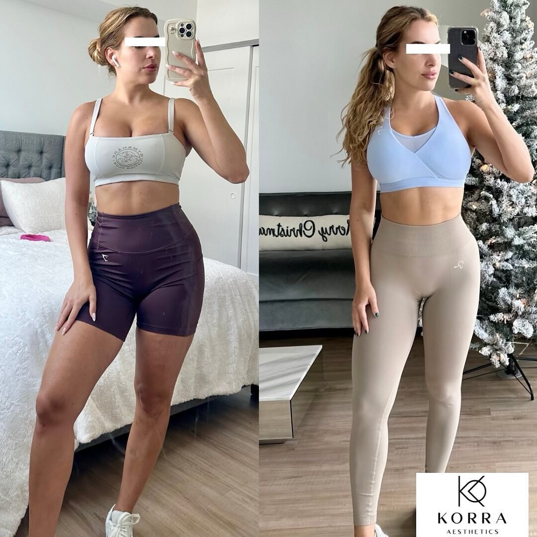 ☀️👙 With summer around the corner in Miami, it&rsquo;s always bikini season! 🌴 See how our 31-year-old patient has achieved a more toned stomach and slimmer thighs and lost 9 pounds in just 1 month on Compounded Semaglutide!

Let&rsquo;s work toget