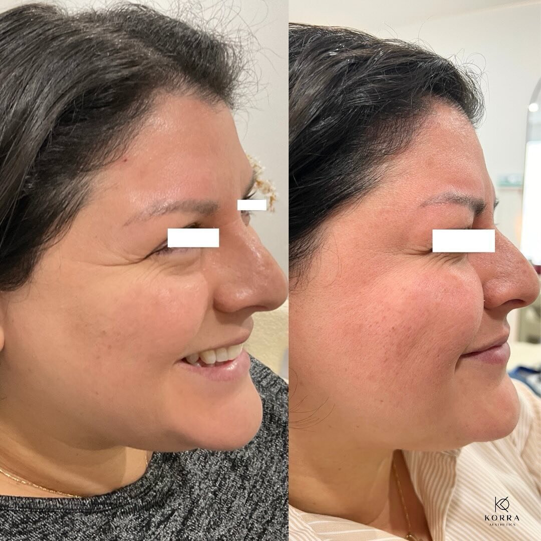 Transform your crows feet into smooth, youthful skin like our amazing patient did with just 24 units of Botox! ✨ 

Ready for a fresh look? Click the link in our bio to make your appointment today! 🤍
.
.
.
.
.
#BotoxBeauty #youthfulskin #miamibotox #