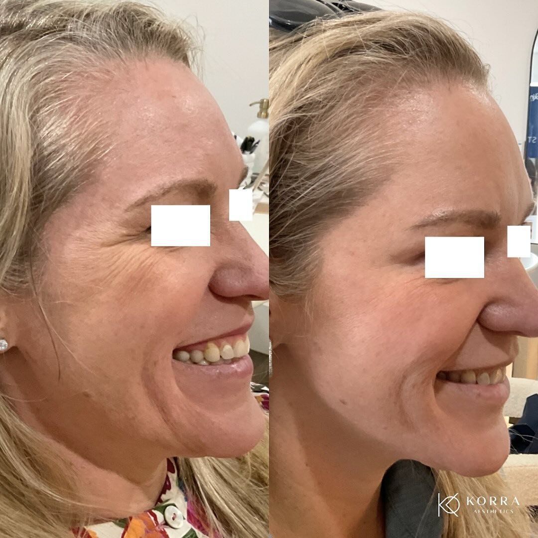 Say farewell to crow&rsquo;s feet and hello to flawless skin! Our patient is glowing after her Botox treatment, with those pesky wrinkles nowhere in sight. 

Ready to unveil your rejuvenated look? Secure your appointment today through the link in our