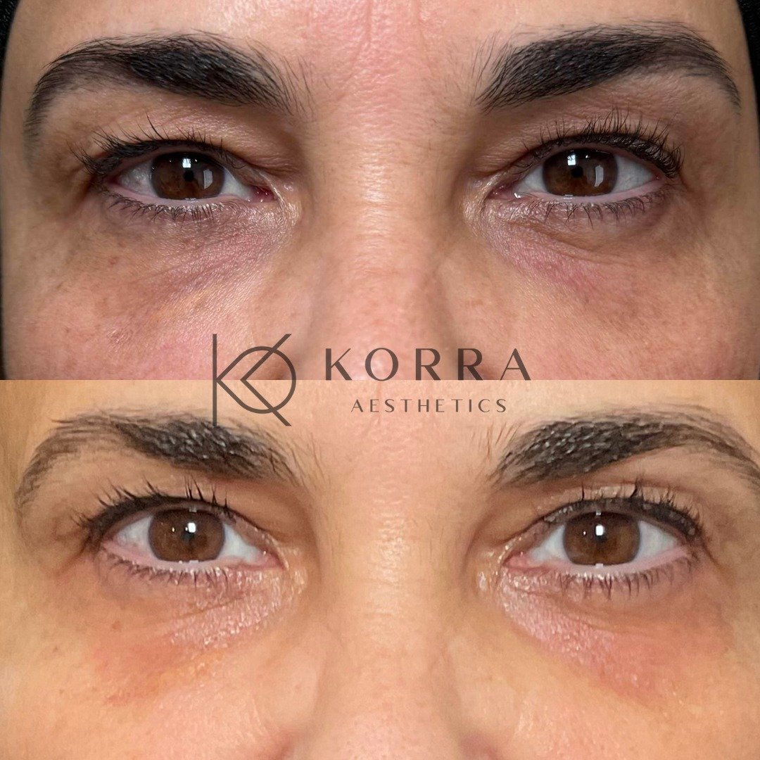Instantly refreshed eyes, diminished dark circles, and a rejuvenated glow has everyone asking for our client's secret!

Our client recently underwent our signature Radiant Eyes Renewal Treatment utilizing Mesotherapy. Each of her four sessions, space