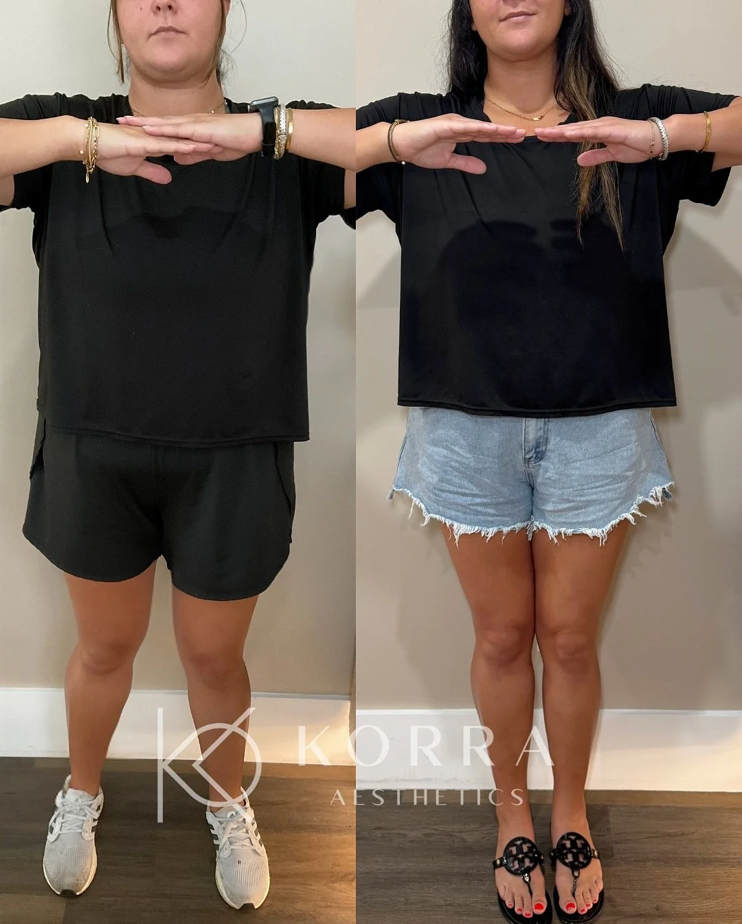 Feel-Good Friday Motivation! 

August is around the corner&mdash;back-to-school season is almost here! It&rsquo;s the perfect time to focus on YOU and set new health goals. Our incredible 29-year-old patient began her journey at 260 lbs and, one year