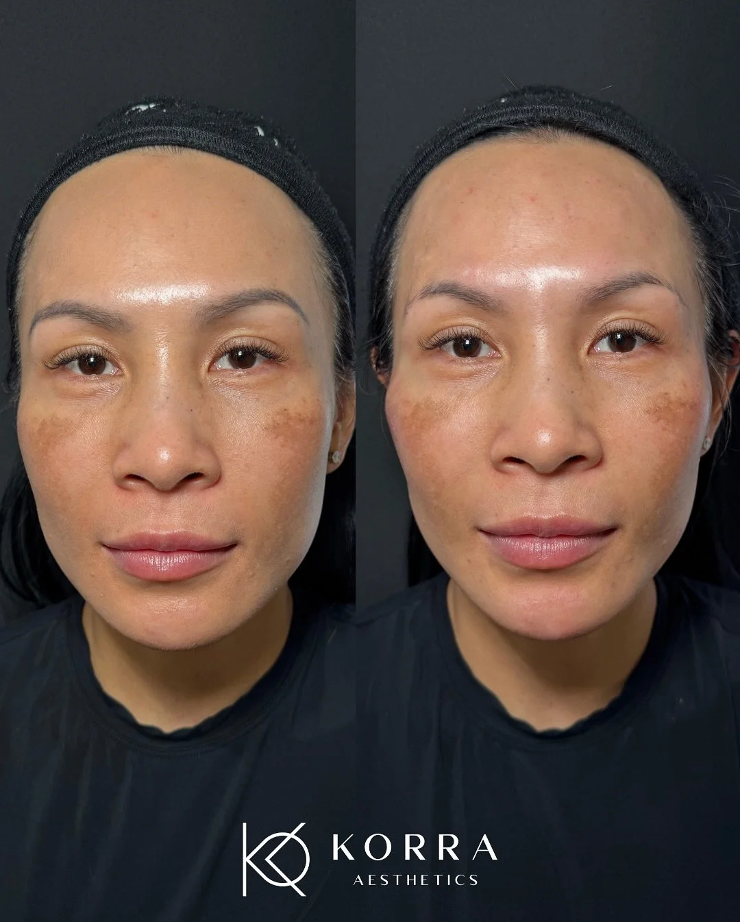 Our beautiful 42-year-old patient traveled all the way from Estero, FL to see us! She received both Botox and Restylane Contour. While Botox results aren&rsquo;t shown here, we used 1 syringe of Restylane Contour in her cheeks for a more defined and 