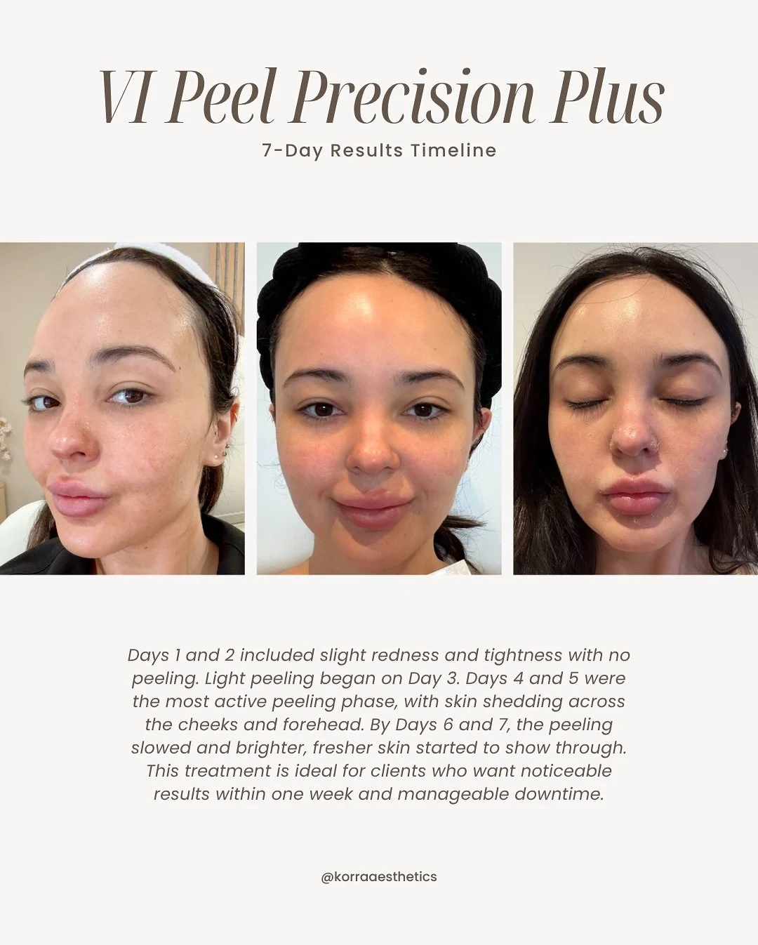 Our founder completed the VI Peel Precision Plus so clients can see a true 7-day transformation.

This peel targets dark spots, sun damage, acne marks, and dullness using brightening and resurfacing ingredients.

Photos show the full progression from