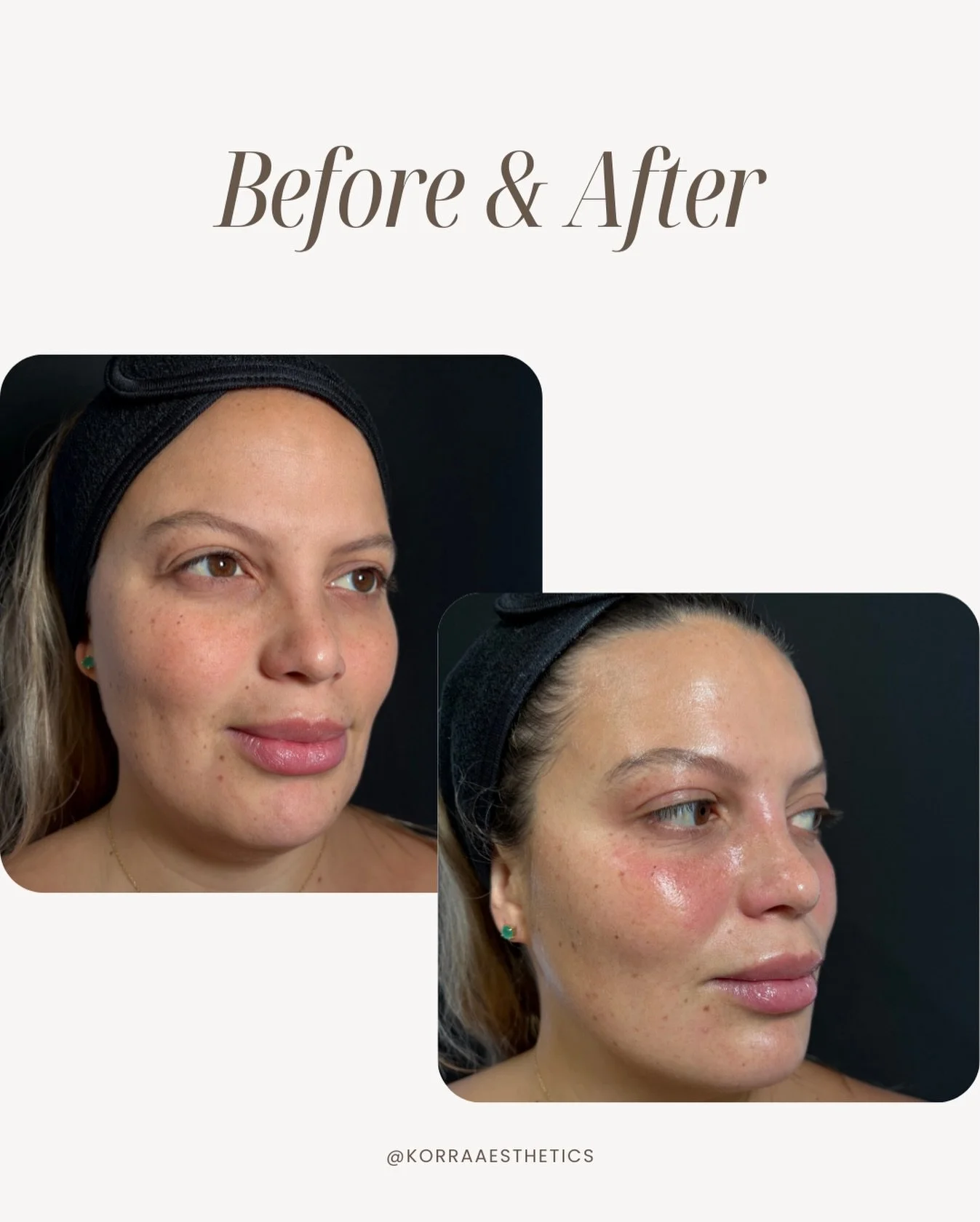 ✨ 33 &amp; glowing again ✨
She&rsquo;s a new mama, a powerhouse in her field, and someone who pours into everyone but herself. Today&hellip; she finally came in to refill her own cup.

One Signature Facial with Kassandra &mdash; clinical exfoliation,