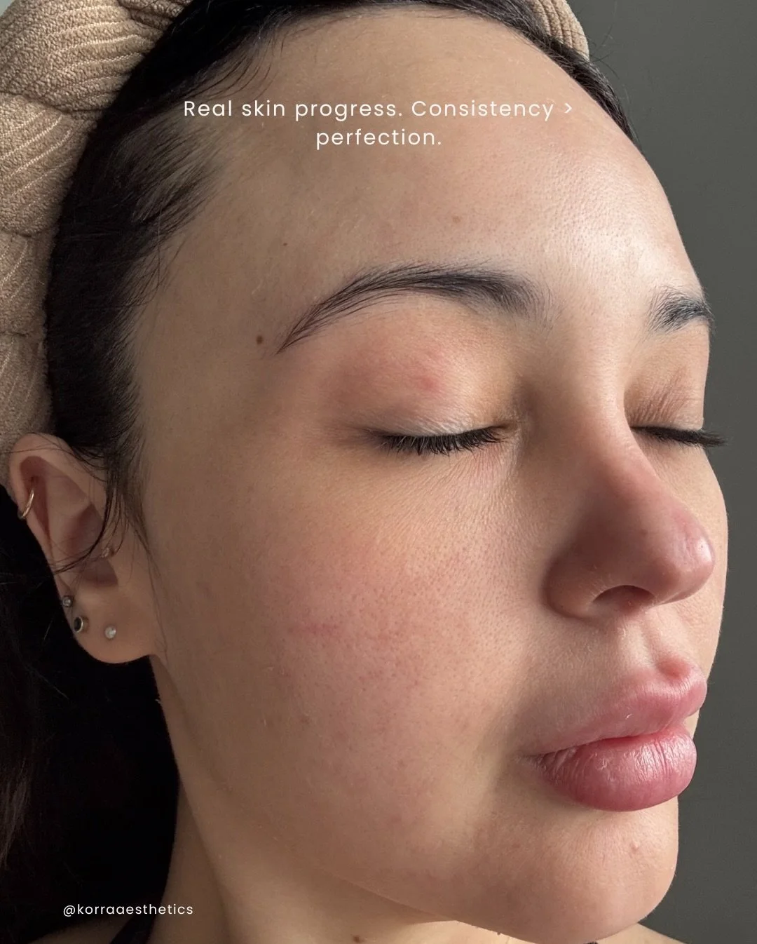 Consistent, professional skincare can completely change the look and feel of the skin. This transformation shows how targeted facials, chemical peels, and a personalized routine can smooth texture, soften acne scarring, and restore a healthier, more 