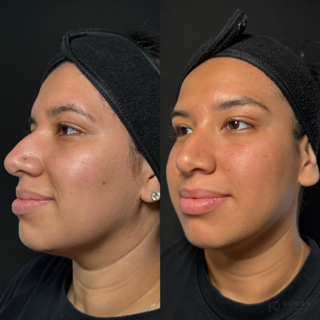Thinking about starting your skin journey before the New Year?

This before &amp; after was taken 4 months apart, with no makeup and no filters. Real, consistent progress with no downtime and a customized plan.

Free skin analysis consultations with 