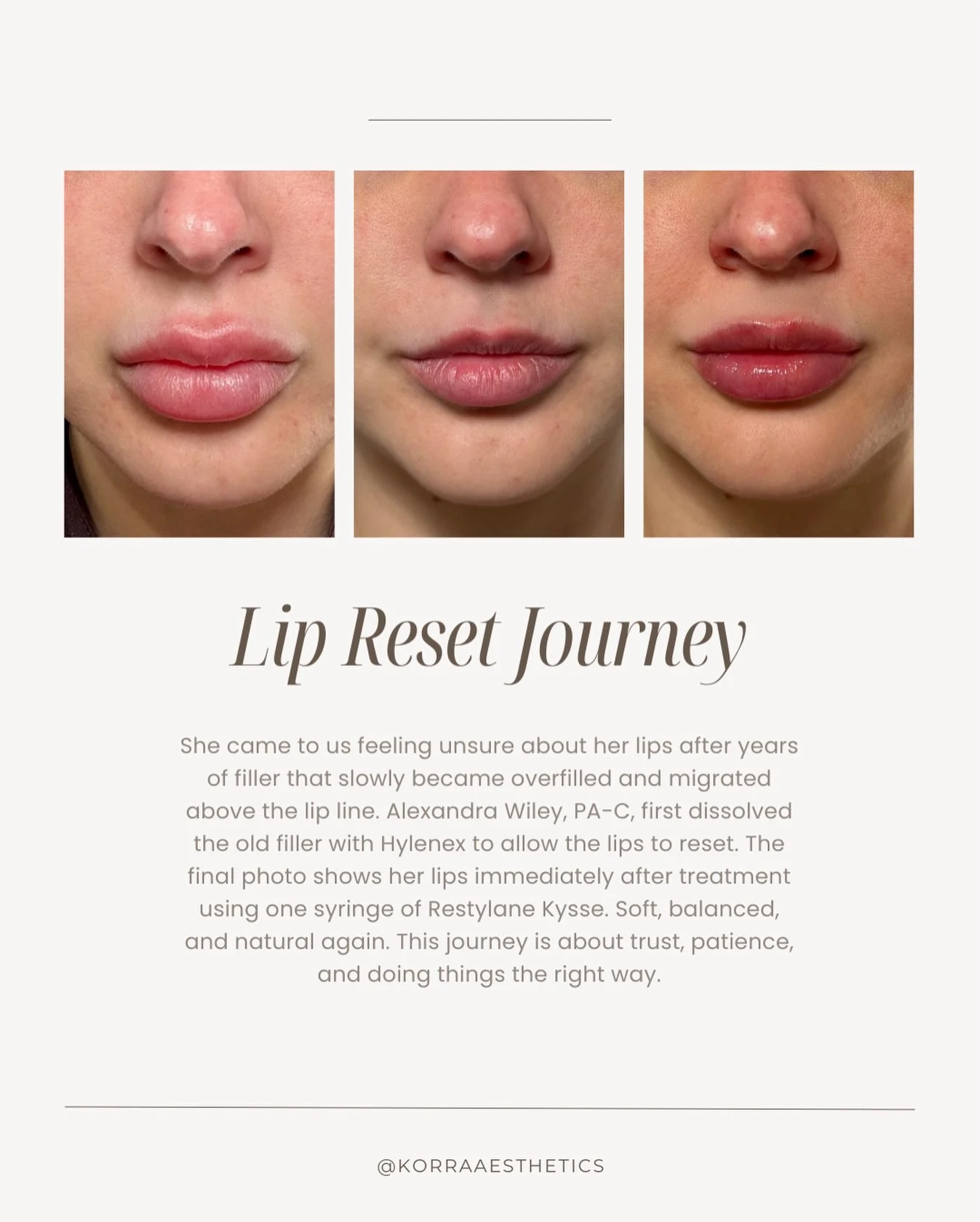 Not every lip appointment starts with adding more filler. Sometimes, it starts with listening.

This client came in feeling unhappy with how her lips had changed over the years. The filler had migrated and no longer felt like her. With Alexandra Wile