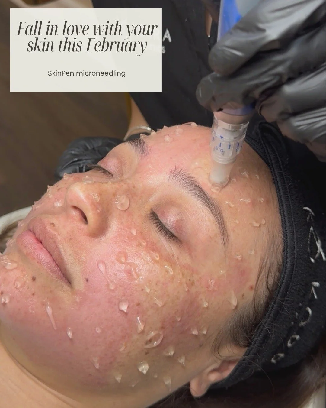 February is the perfect time for a skin reset 🪞

SkinPen microneedling helps improve texture, soften acne scars, smooth fine lines, and stimulate natural collagen for real skin change (not just temporary glow).

And right now, SkinPen is offering a 