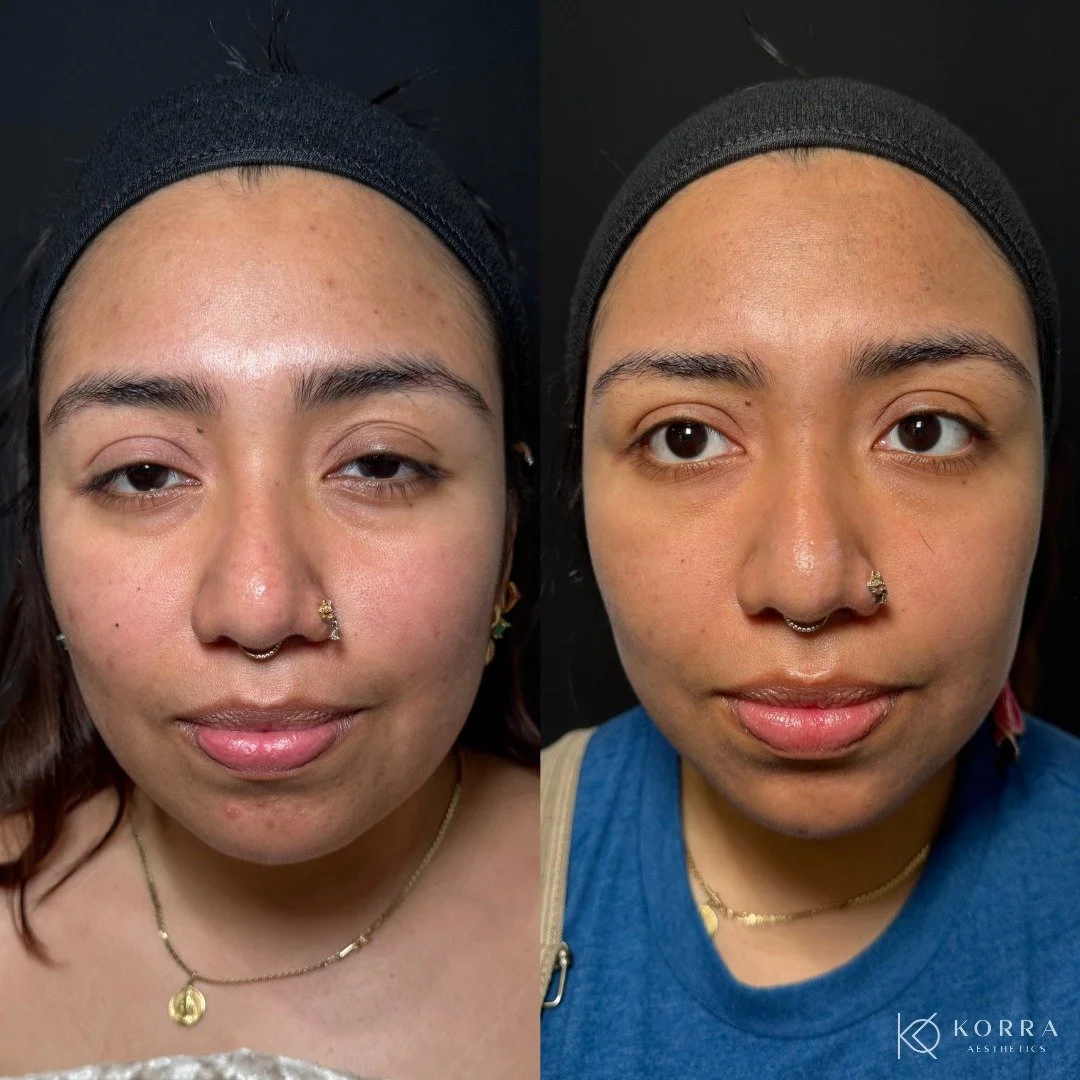 Our 29 year old client just completed her VI Peel series of 3
2 VI Peel Originals and finished strong with VI Peel Precision + Peptides.

Peptides help boost collagen, improve texture, and support faster skin renewal making that final peel the perfec