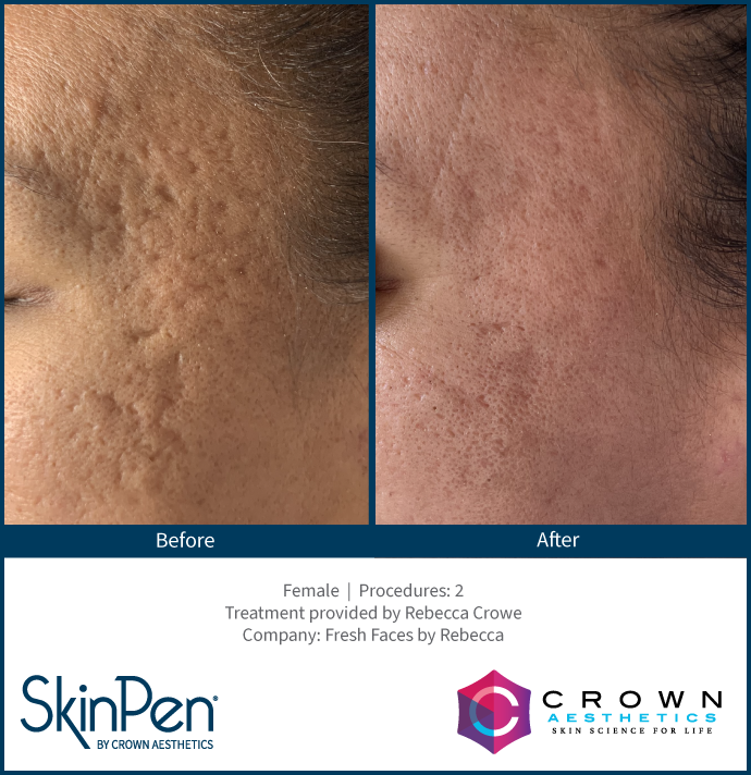 BA-SkinPen-Acne_FreshFaces_RebeccaCrow.png
