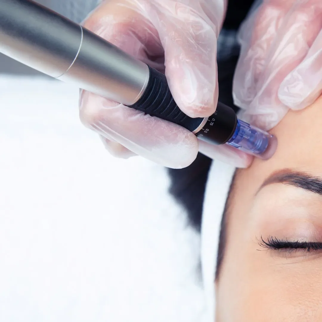 $199 Microneedling