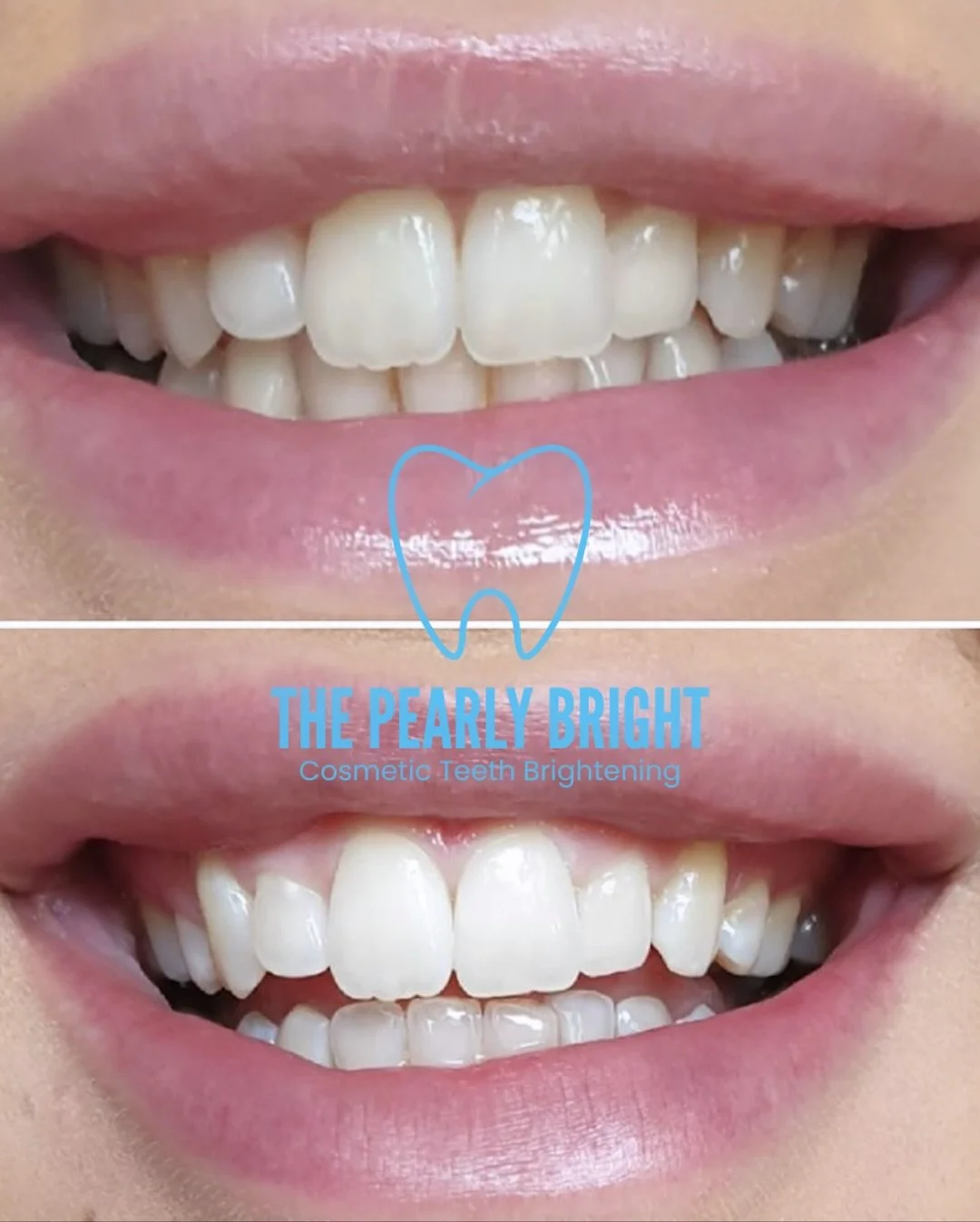 ✨&hellip;

When you book a slot in a chair at The Pearly Bright, you&rsquo;re in control from start to finish &mdash; each cosmetic teeth whitening session is completely self-administered, pain-free, peroxide-free, vegan, and cruelty-free.

Choose yo