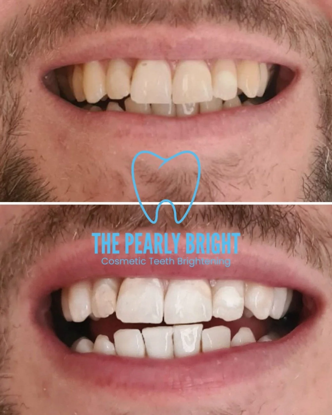 Here at The Pearly Bright in Blantyre, we offer a cosmetic teeth brightening experience that&rsquo;s safe, insured, and fully compliant with UK cosmetic regulations.

We&rsquo;re proud to partner with Naturawhite, one of the UK&rsquo;s longest-establ