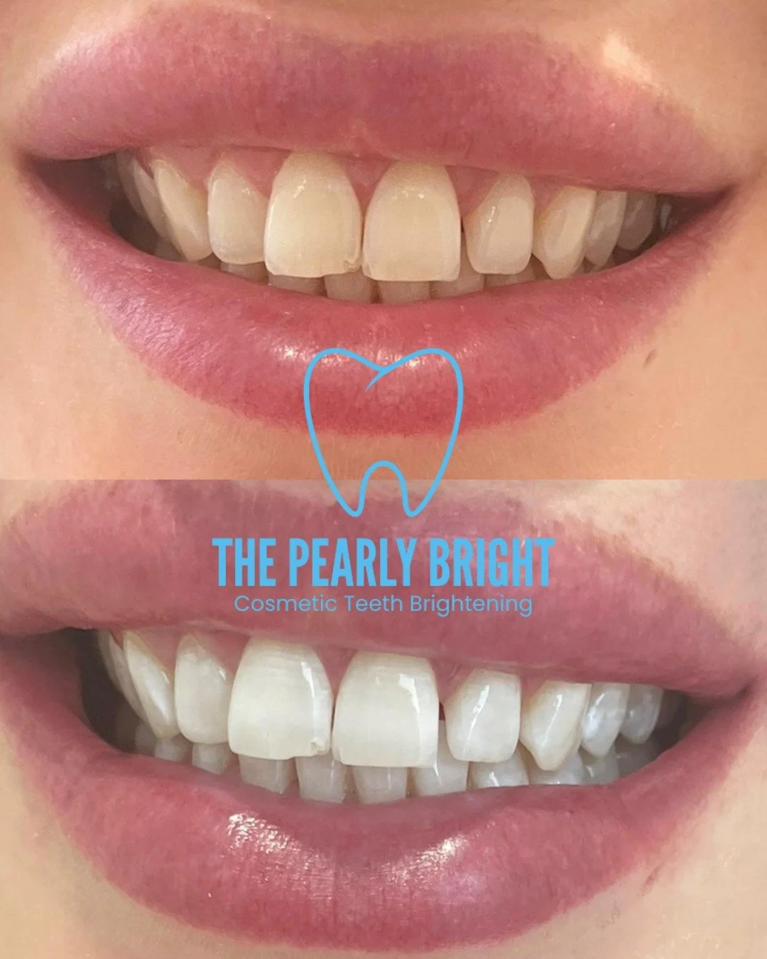 🚀 The Power of Naturawhite BluForsaX ✨

At The Pearly Bright, we offer visitors the use of BluForsaX by Naturawhite &mdash; a professional-grade cosmetic whitening gel designed to deliver safe, visible results.

BluForsaX works through a gentle oxid