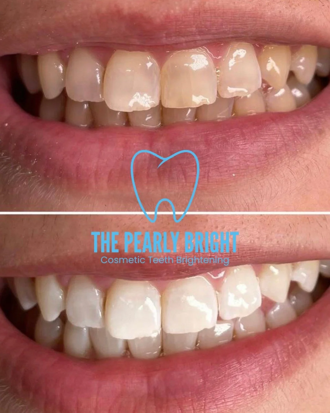 At The Pearly Bright we use the Naturawhite system with their BluForsa gel. A professional cosmetic whitening formula designed to safely lift stains and boost brightness.

Here&rsquo;s why clients love it 👇

💎 Up to 16 shades lighter in one session