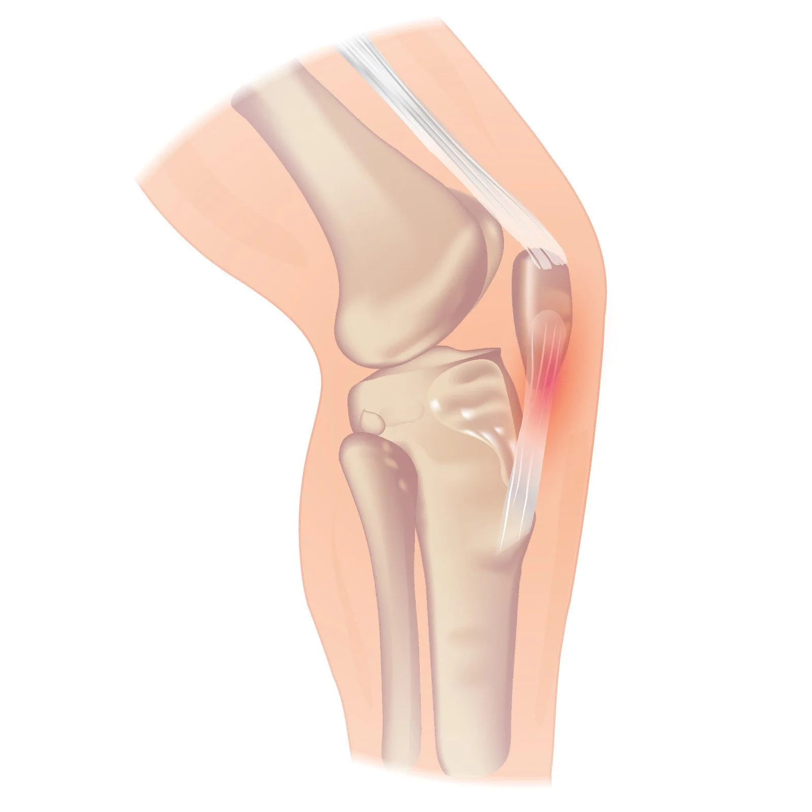 Jumper's Knee