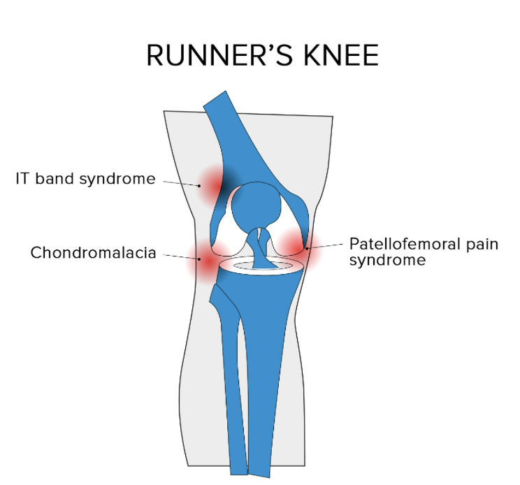 Kevin’s Story (Runner’s Knee)
