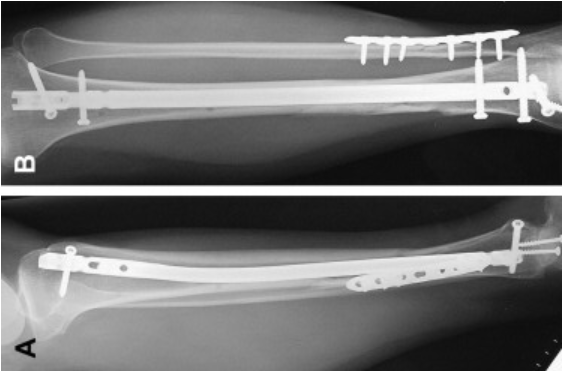 The Compound Fracture