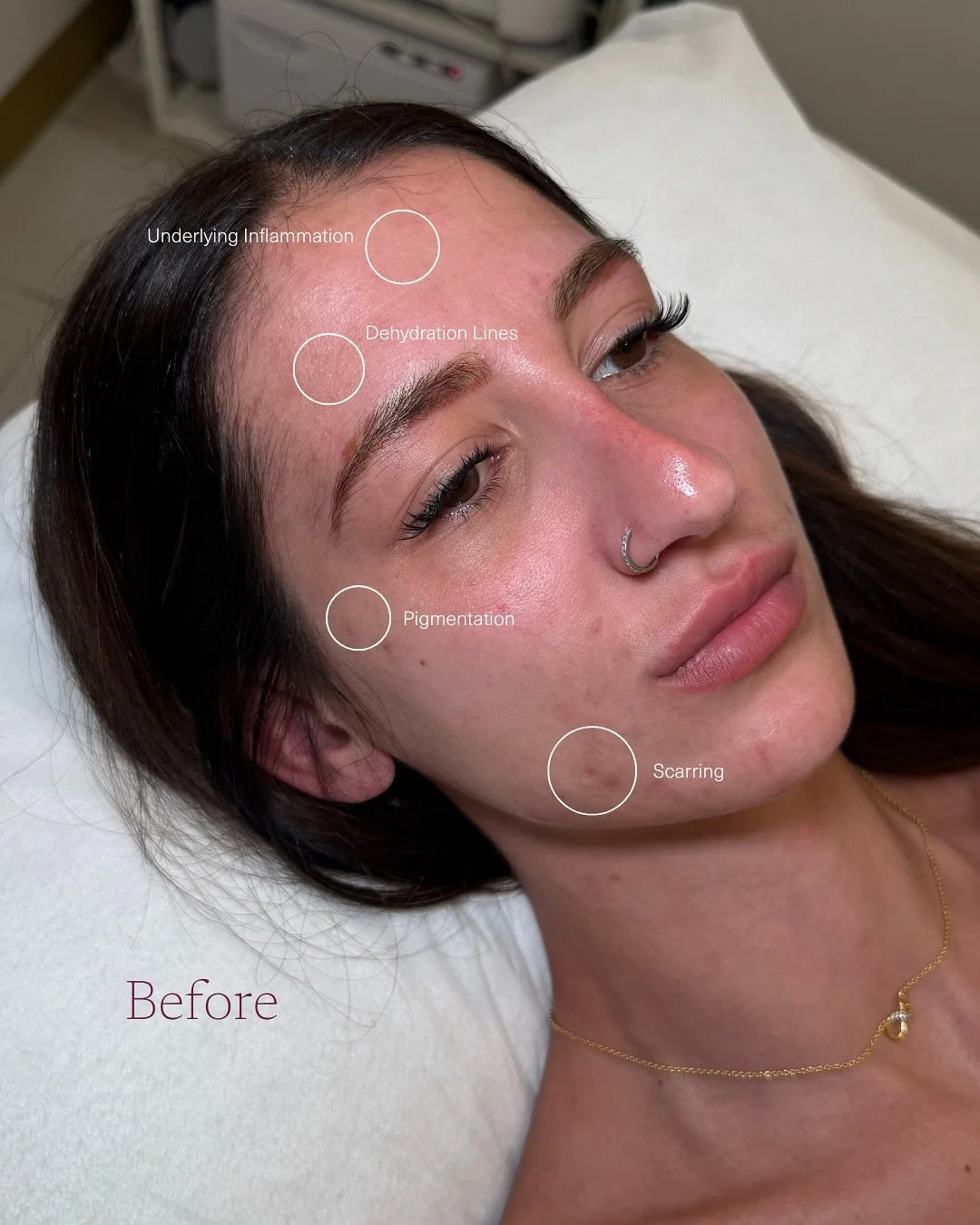 SKIN ANALYSIS EXPLAINED ✨

Understanding your skin is the first step toward creating a treatment plan that&rsquo;s tailored to you and your goals.

Our client came to us with a few ongoing skin concerns, which we&rsquo;re now addressing through regul