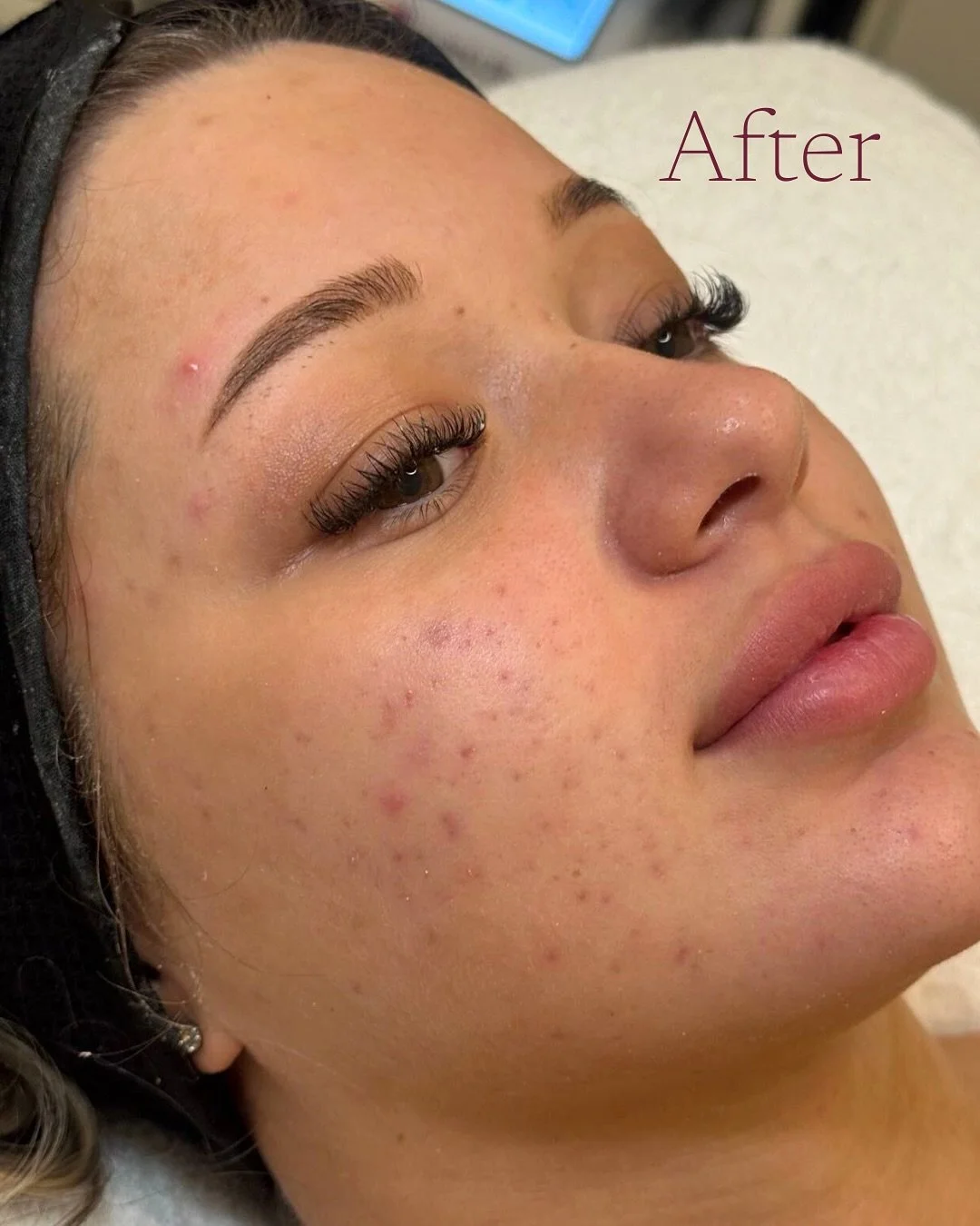 Swipe to see what we started with ➡️ 🙊

We&rsquo;ve spent the past several months rebuilding our client&rsquo;s skin.

Starting with calming her active acne and congestion, then strengthening her barrier through tailored treatments and a home care p