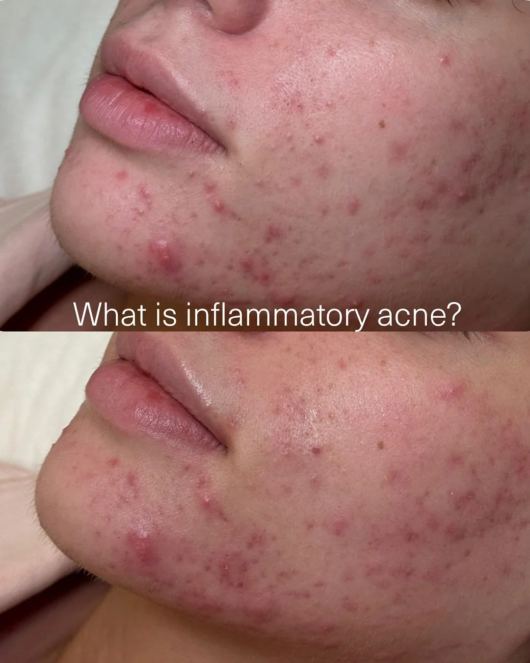 Inflammatory acne goes deeper than your usual breakouts. It&rsquo;s driven by underlying inflammation within the skin and, often the body itself.

When addressing inflamed acne, our focus is on calming irritation, repairing the skin barrier, and elim