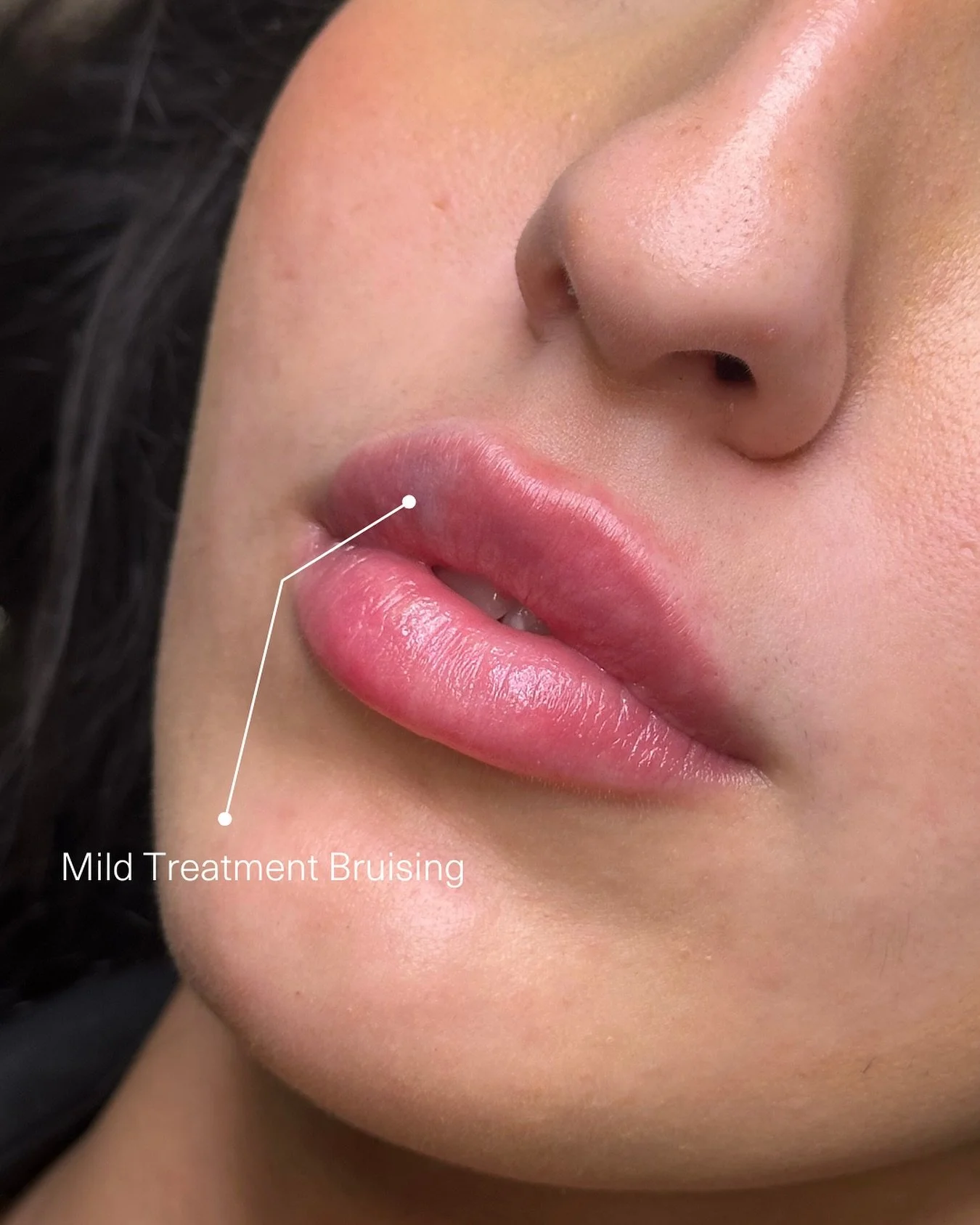 Bruising is one of the most common concerns clients have when it comes to cosmetic treatments, and completely understandable. 

It&rsquo;s a natural response from the body and can vary from person to person depending on factors like skin sensitivity 