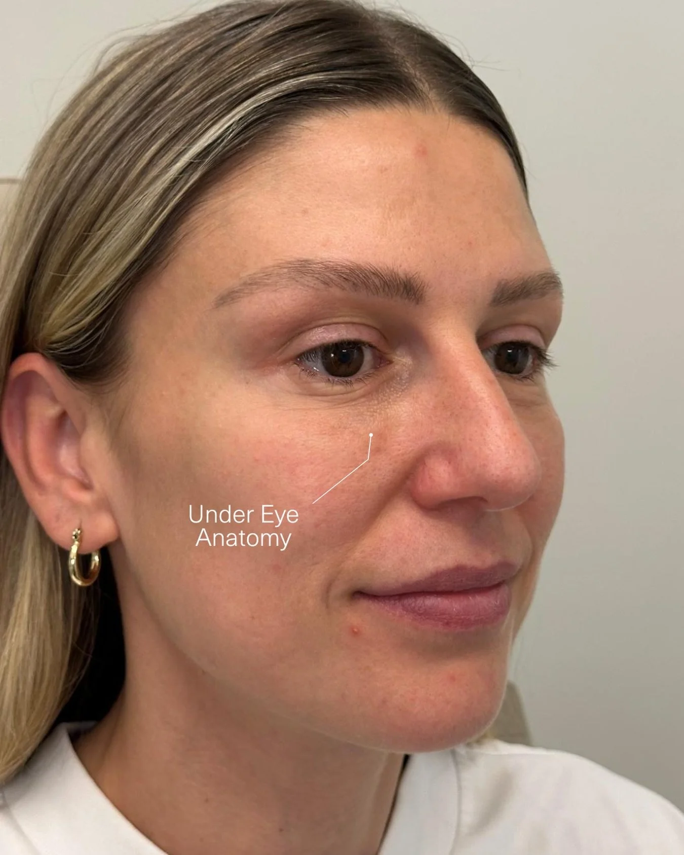 If you&rsquo;ve noticed changes around your under eye area, it&rsquo;s usually not caused by one factor alone.

This delicate region can be influenced by your natural anatomy, genetics, hydration, sleep quality and gradual shifts in skin texture over