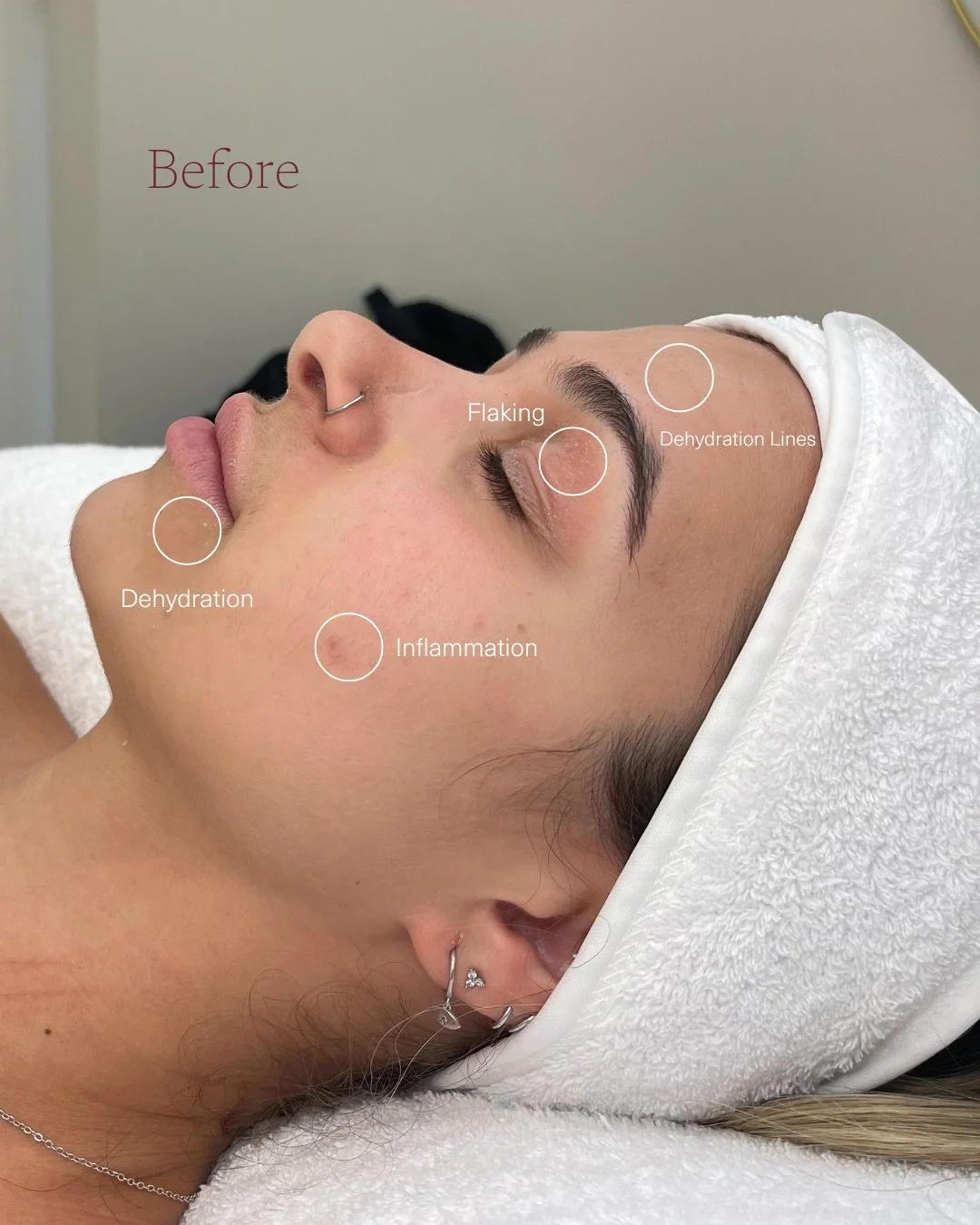 Skin needling works by stimulating controlled micro channels into the skin 🪄

This then encouraging the skin&rsquo;s natural renewal processes, helping improve texture, hydration retention and recovery over time. 

While one session can bring visibl
