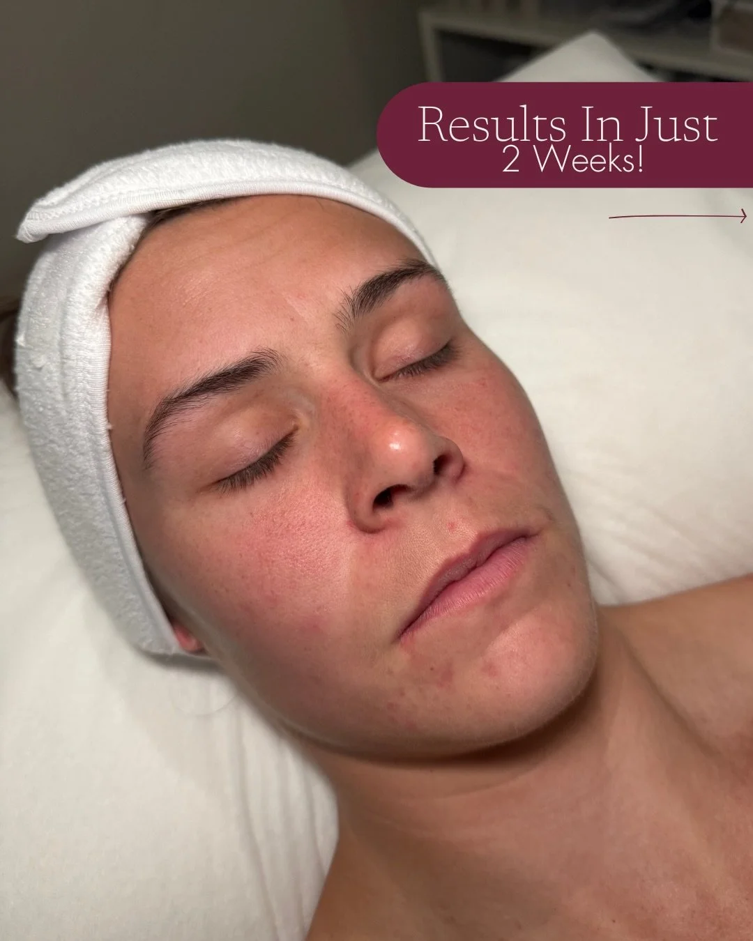 Swipe to see what we started with &hellip;

A 2 week transformation supported by skincare alone!

This client presented with post acne scarring and dermatitis around the mouth and cheeks.

After a thorough consultation, a targeted at home routine was