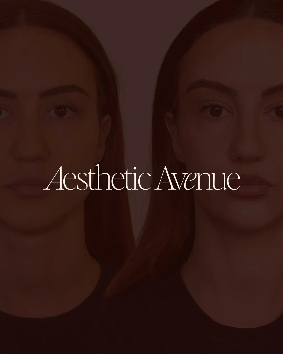 The masseter muscles are located at the sides of the jaw and play a key role in chewing and jaw movement.

In some individuals, these muscles can become overactive due to factors such as clenching, grinding, stress, or habitual tension. When this hap