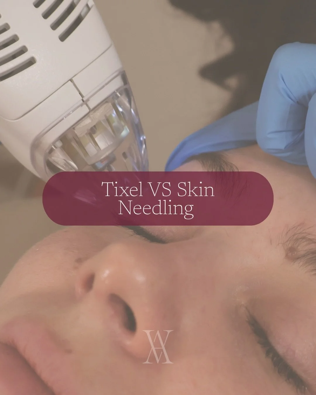 As we introduce our new skin device, Tixel, one of the most common questions we&rsquo;ve had is: Skin Needling or Tixel?

The truth is neither is &ldquo;better.&rdquo;

They simply serve different purposes.

Skin needling uses fine needles, and Tixel
