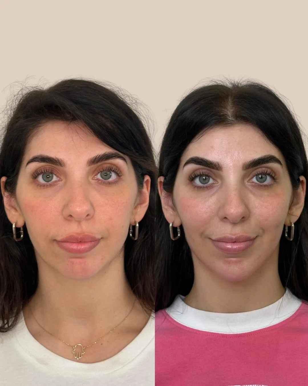 The lower face plays a key role in overall facial harmony and balance. 

Over time, changes in skin elasticity, fat distribution, and muscle activity and structural support can affect the jawline, chin, and perioral area.

Facial balancing focuses on