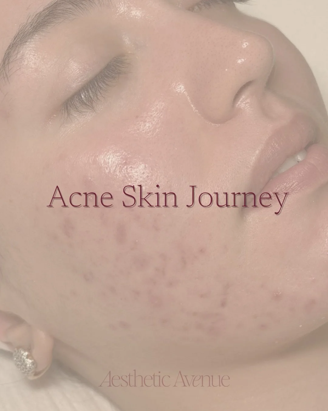 Acne is a journey, not a quick fix!

Meet one of our clients. She&rsquo;s been committed to her skin since January, and the results speak for themselves. From day one, she&rsquo;s been supported with cosmeceutical skincare at home - and that consiste