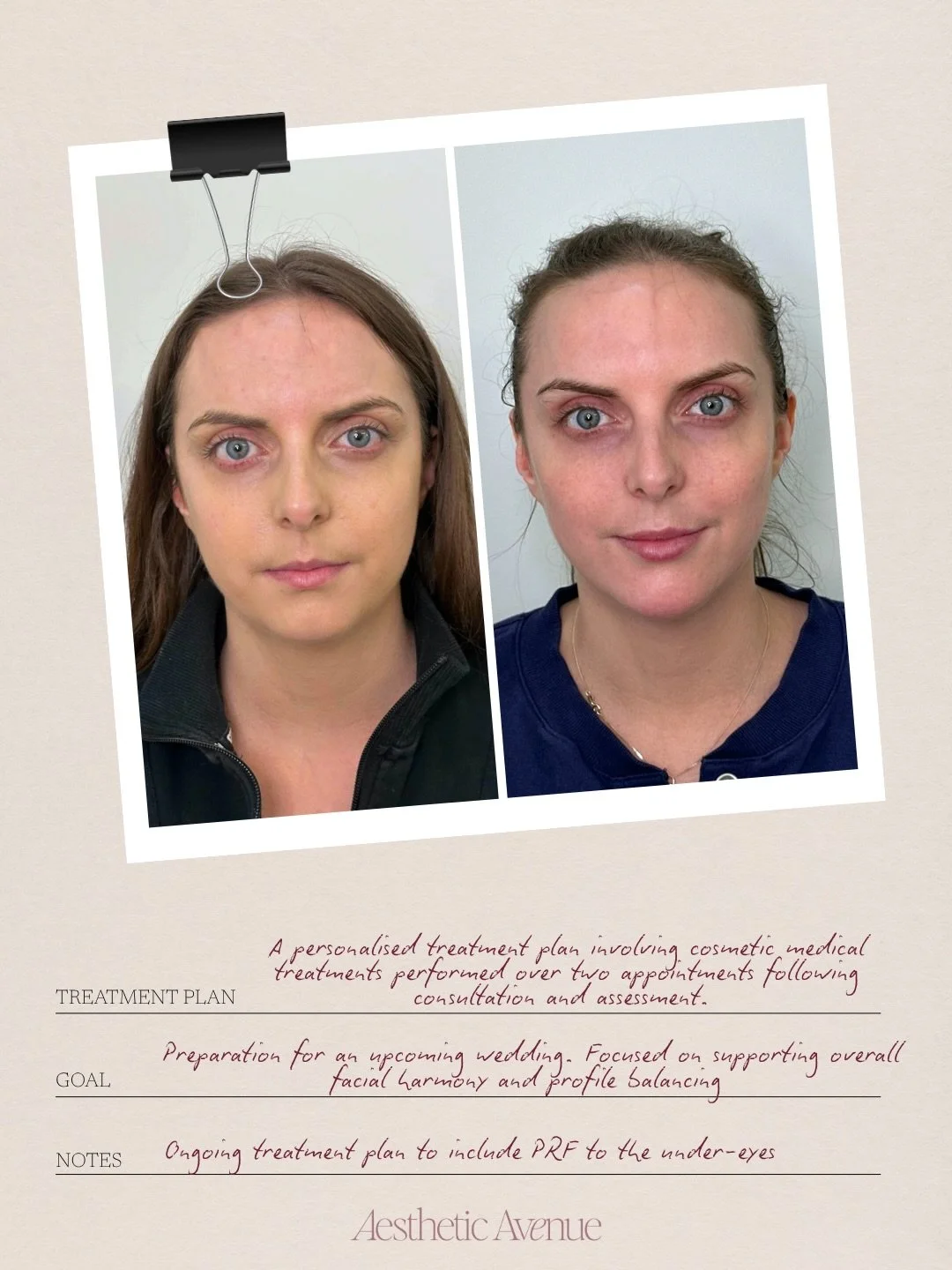 Facial balancing is a treatment approach that considers the face as a whole.

Looking at proportions, symmetry, and harmony between features. At our clinic, we take time to assess your individual anatomy before any treatment, so that outcomes are tai