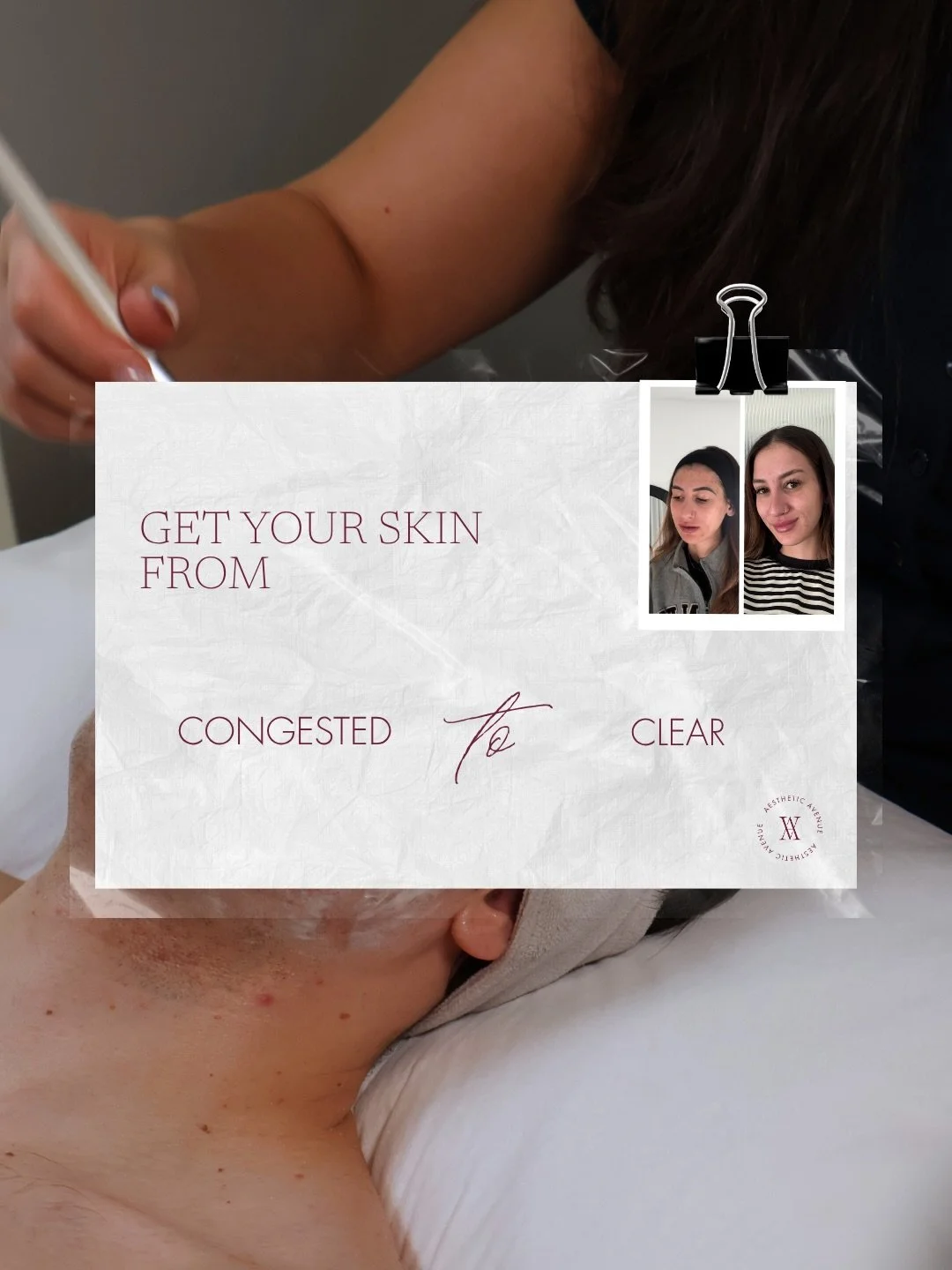 Let&rsquo;s keep it straightforward and clear.

When it comes to your skin journey, there are four key steps to understand and commit to.

It&rsquo;s not a one treatment, in and out approach.
Clearing and improving your skin takes time, consistency, 