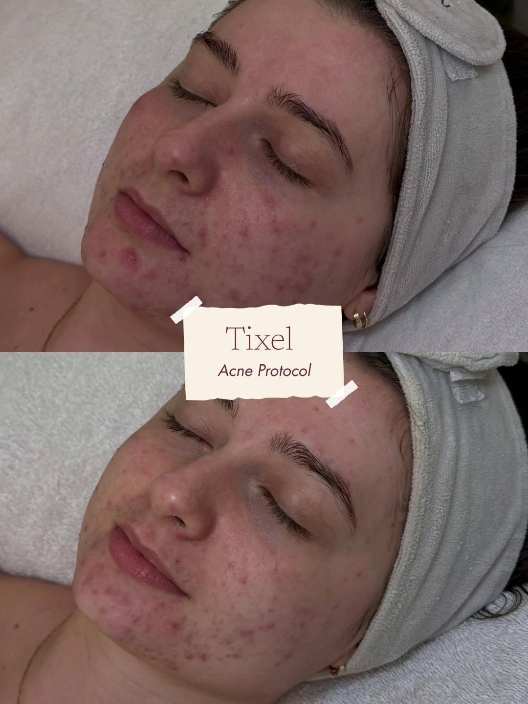 This is our beautiful client Elma 🤍

When she first came to us her concerns were her active hormonal acne.

Her treatment plan consisted of Tixel treatments every 2 weeks.

She has been consistent on her at home routine and within 3 sessions we have
