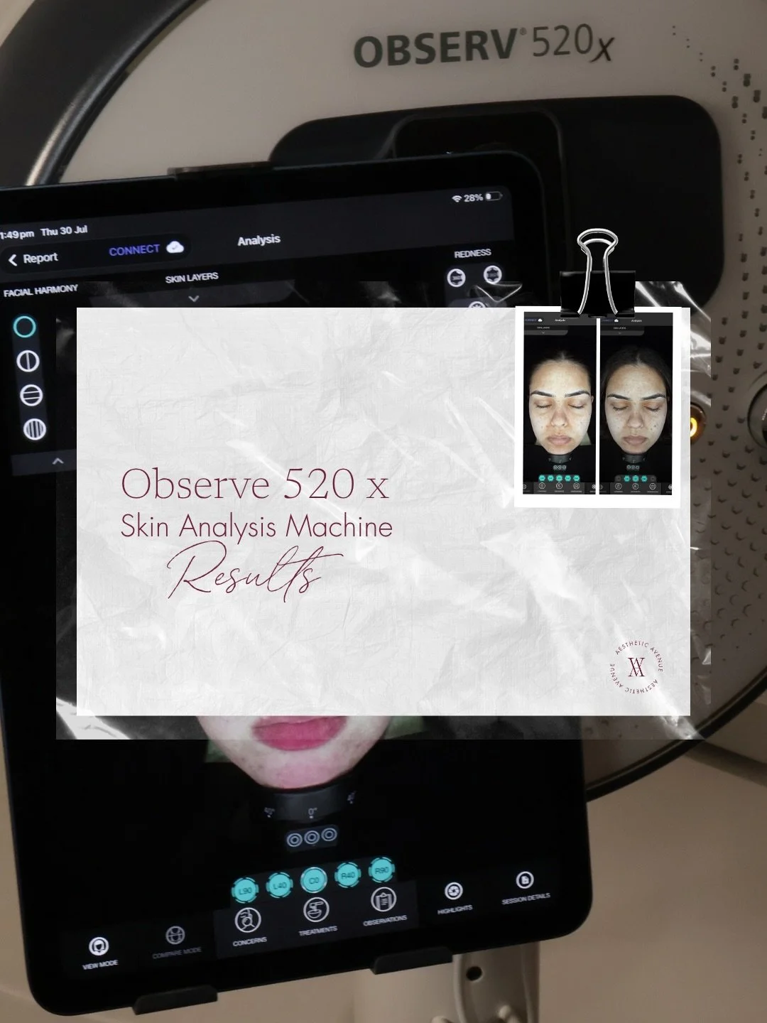 Documenting your skin&rsquo;s progress is one of the most accurate ways to understand how it&rsquo;s responding to treatment.

Our Observ 520x skin analysis uses different visualisation filters to show what&rsquo;s happening beneath the surface, from