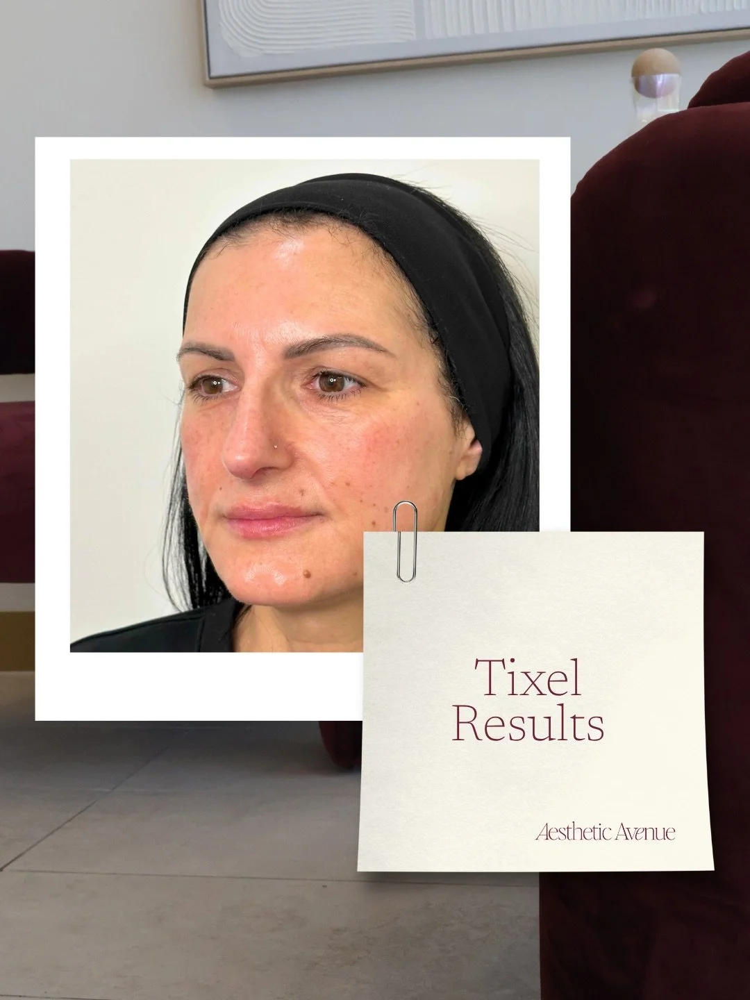 Healthy, refreshed skin is usually the result of a few considered steps rather than one treatment.

This client&rsquo;s plan began with restoring support through volume replacement, followed by a course of 3 Tixel treatments to improve texture, brigh