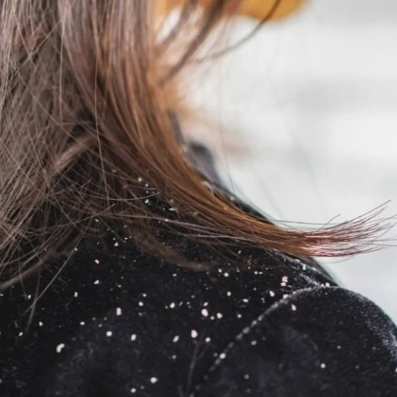 How to Get Rid of Dandruff Fast: The Ultimate Guide