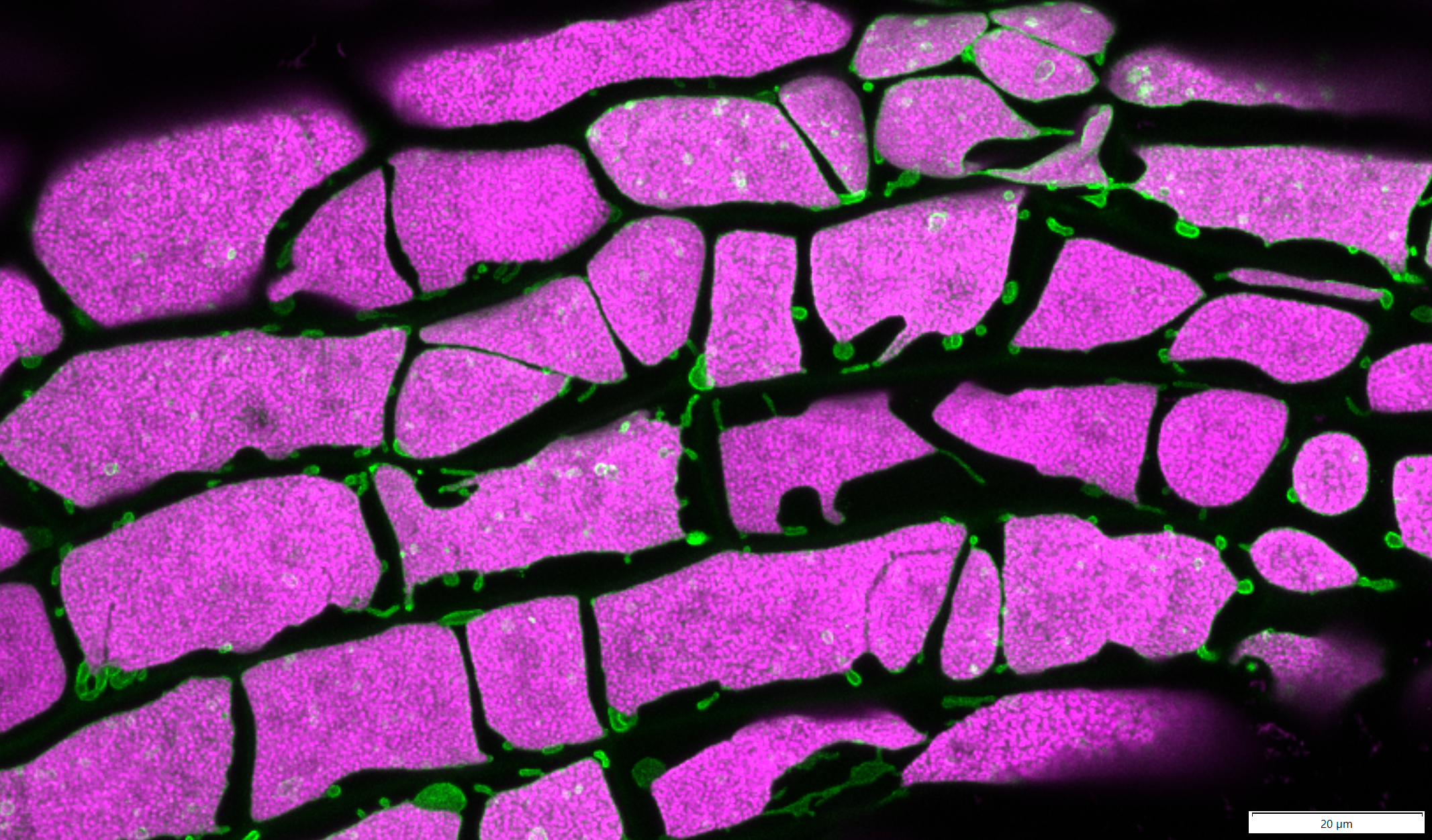 This is what happens to the moss (Physcomitrium patens) chloroplasts when we grow cells on β-lactam antibiotics. β-lactams inhibit the synthesis of the peptidoglycan in the chloroplast envelope, leading to their dramatic expansion. 
Magenta - chlorop