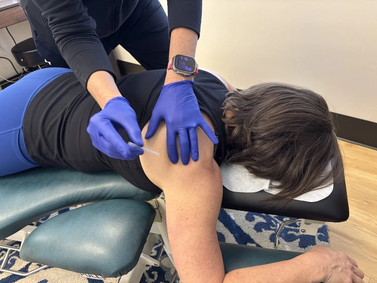 Nancy-dry needling-2.JPG